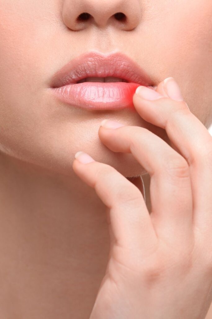 herbal remedy for cold sore on lip